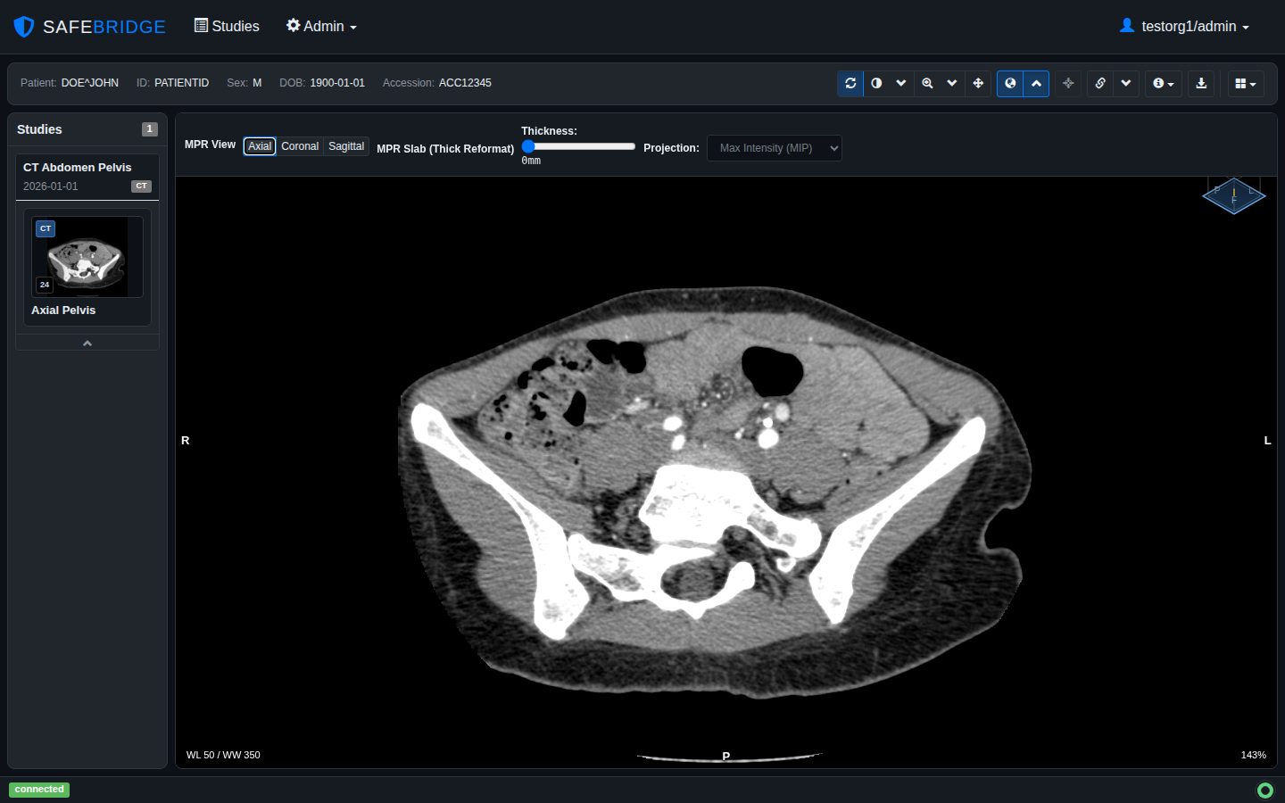 SafeBridge DICOM viewer showing an axial CT of the pelvis in MPR mode, with slab thickness and MIP projection controls